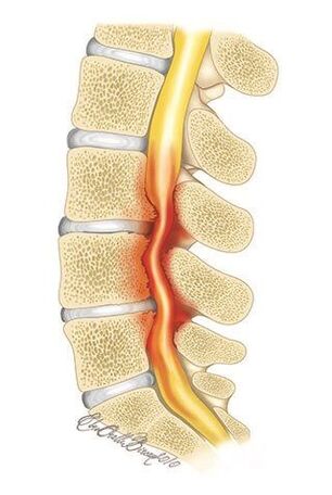 Coa osteocondrose da columna vertebral torácica, hai compresión da canle espiñal