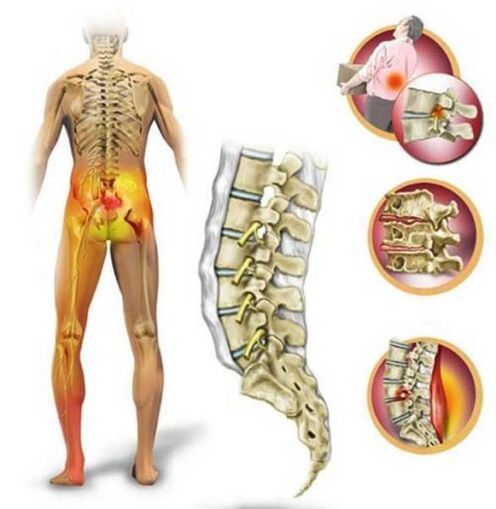 Osteocondrose da columna lumbar que causa dor nas costas