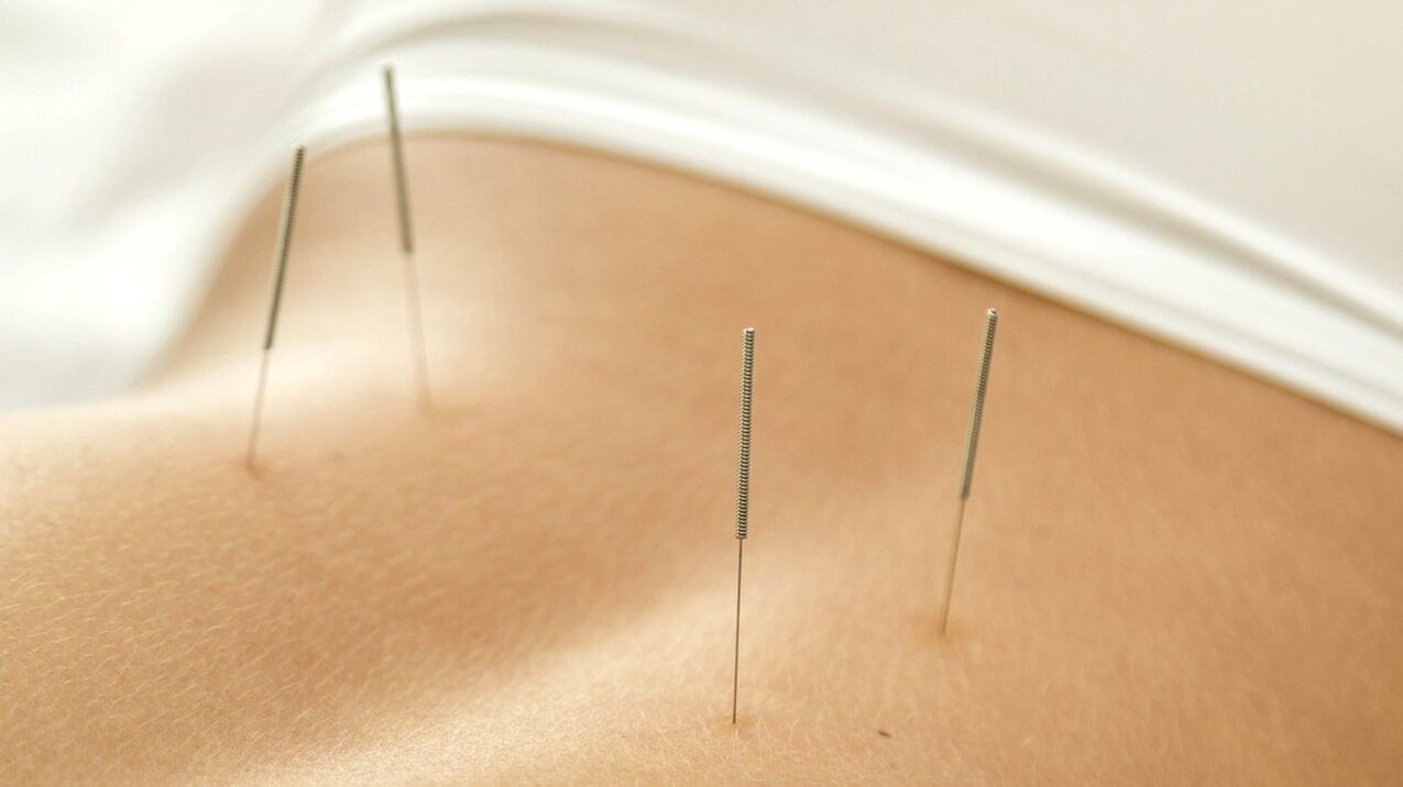 A acupuntura axuda a desfacerse da dor lumbar